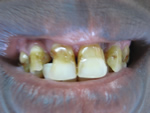 Teeth discolored and decayed due to fluorosis