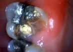 Tooth decay on tooth with old filling