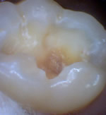 Cavity on a molar tooth