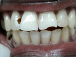 Cavity and chipped tooth