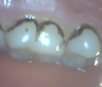 Stains on back teeth